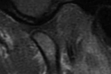 The Role of MRI in Investigating Tinnitus in Adults with a TMJ Disorder